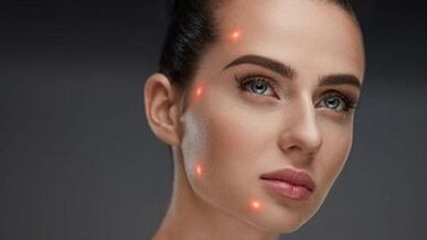 Cos'è il ringiovanimento cutaneo frazionato