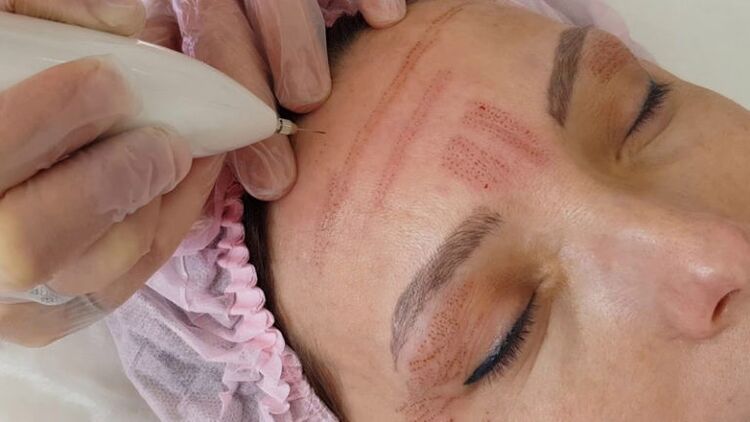 Ringiovanimento del viso al plasma