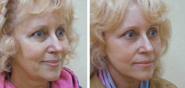 Donna prima e dopo il ringiovanimento della pelle del viso al plasma